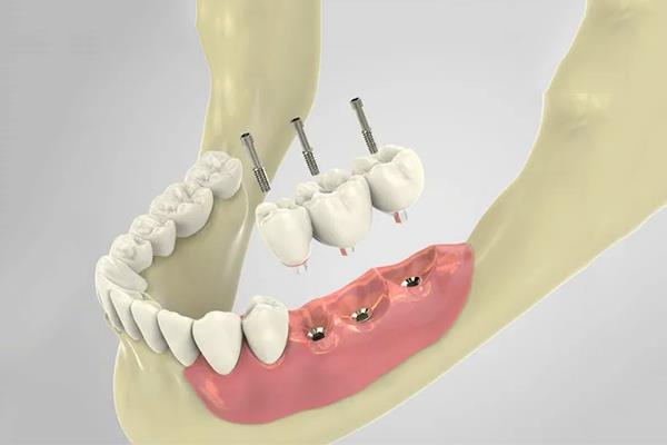 北京种植牙价格解析:从材料选择到服务水平的深度剖析(图1)