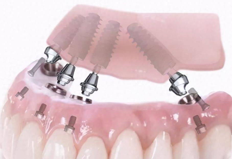 瓜沥地区种植牙价格及国产与进口种植牙深度解析(图2)