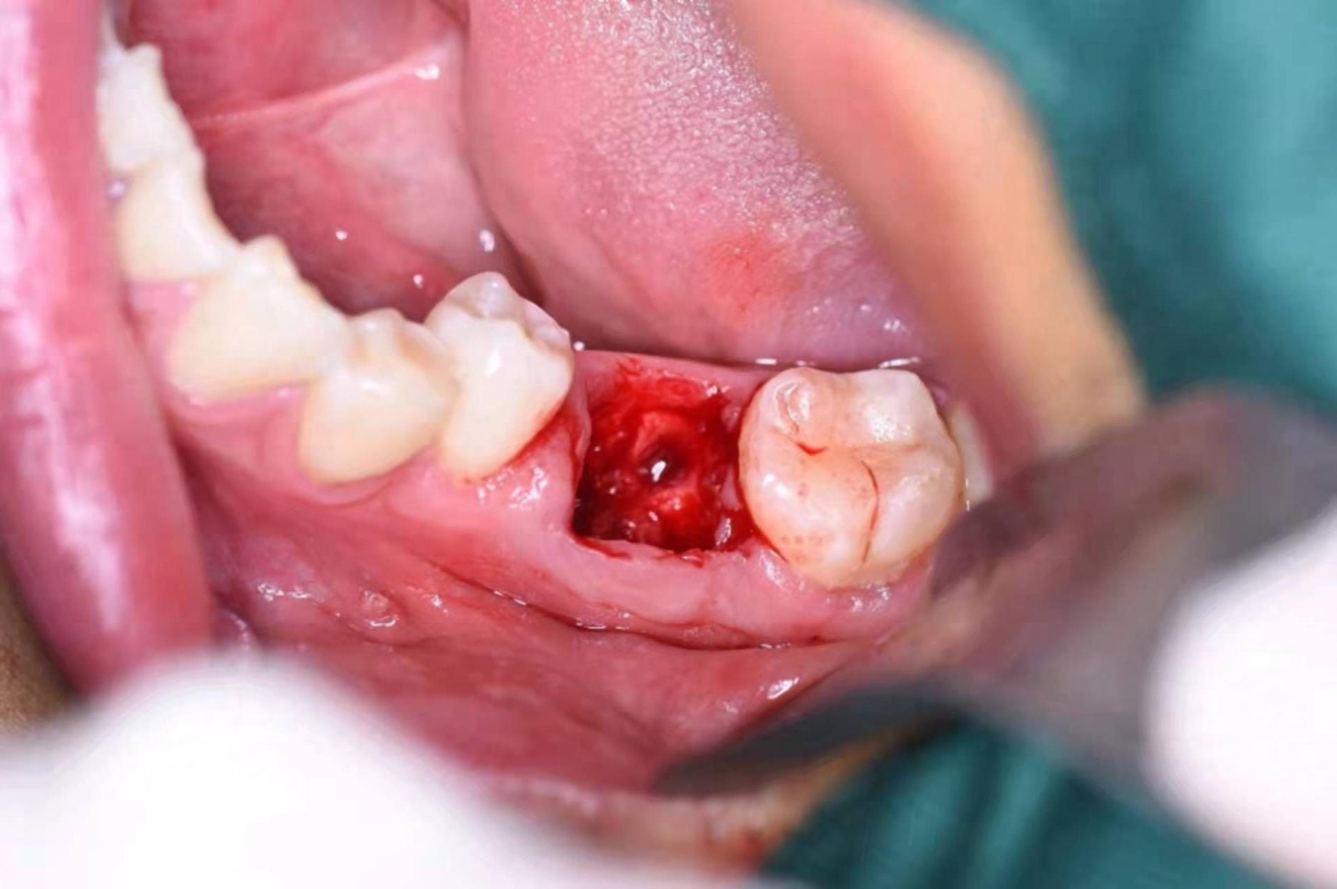 昆明柏德口腔：德国标准种植牙服务，价格亲民，技术先进(图1)