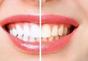 杭州瓜沥区牙齿矫正服务：价格与技术解析(图1)