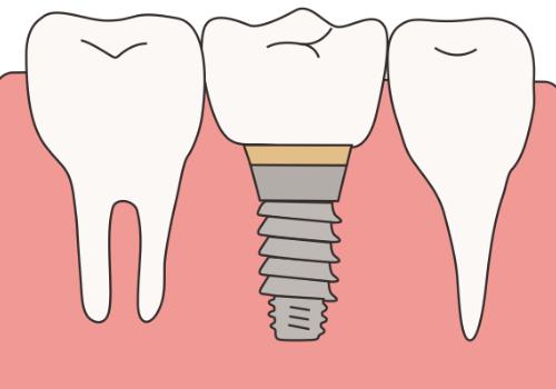 整牙费用全解析：医院与诊所的性价比大比拼