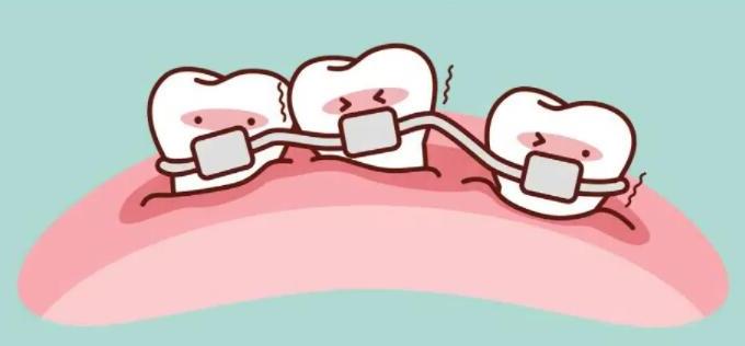 福州种植牙价格全解析：材料、医院等级与手术方式影响因素详解(图2)