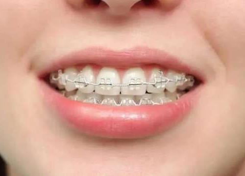 郑州植得口腔医院种植牙价格全解析,经济实惠之选(图2)