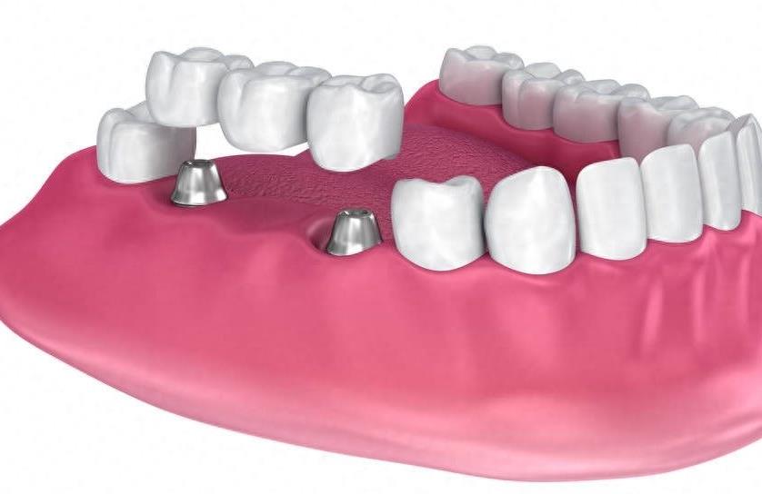 合肥佳德口腔种植牙价格全解析,从经济到高端的全方位选择(图1)