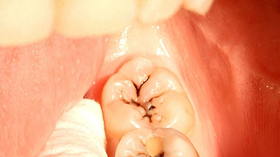 合肥渡江口腔:牙齿治疗价格全解析,合理性与服务并重(图2)