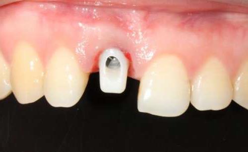 济南种植牙医院推荐:维乐、弗莱堡、可恩口腔,技术精湛且价格合理(图2)