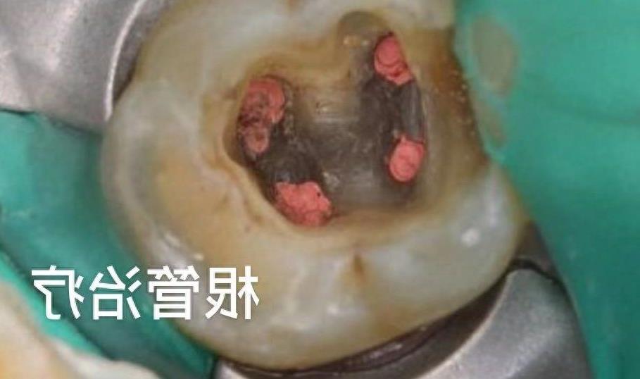 种植牙费用大揭秘:国产与进口品牌价格全解析(图1)