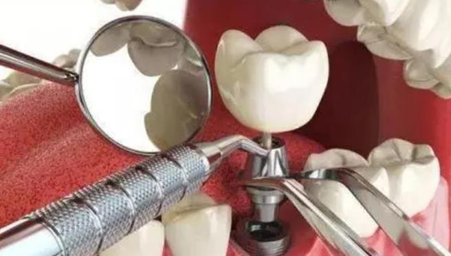 衡水种植牙价格解析:单颗至半口种植牙费用详解(图1)