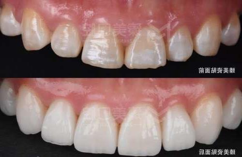 昌平区口腔种植牙全口费用大揭秘,价目表解读(图2)