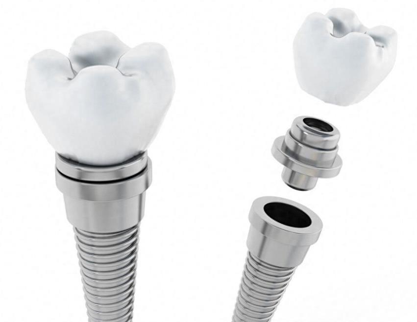 咿呀口腔种植牙服务:价格透明,技术先进,服务至上(图1)