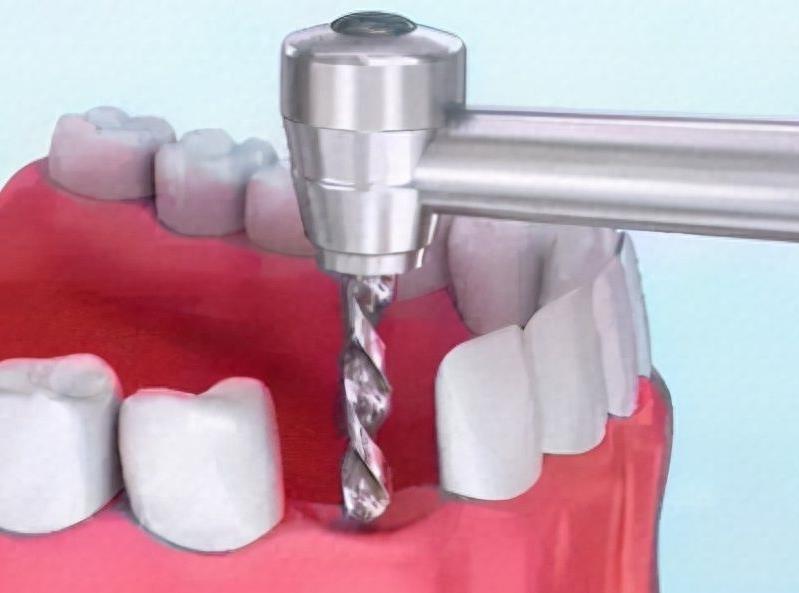 邯郸邯山区牙科诊所推荐：学院路牙卫士口腔隐形矫正服务详解(图2)