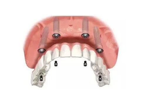 宁波拔智齿哪家医院技术好价格合理？宁波中康美口腔丨宁波恒美口腔专业拔智齿上榜推荐(图2)