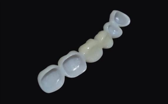 台州牙齿修复选哪种好?全瓷牙、种植牙、烤瓷牙优缺点全面对比(图4)