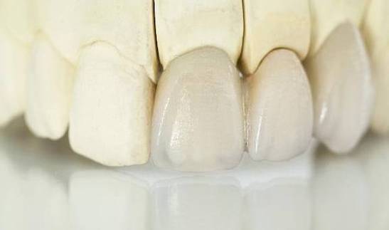 沧州镶牙烤瓷牙价格表及口碑好的口腔医院推荐(图3)