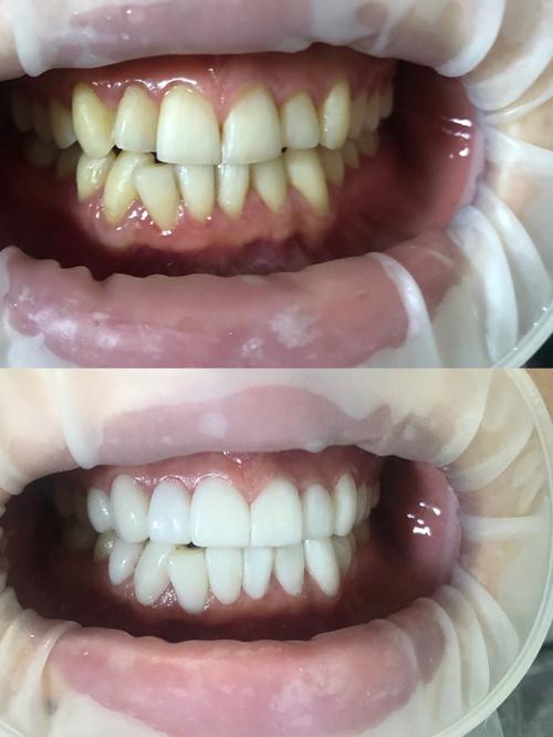 沈阳做全瓷牙冠多少钱?2025最新价格国产900元起、威兰德4000元起、泽康3200元起~