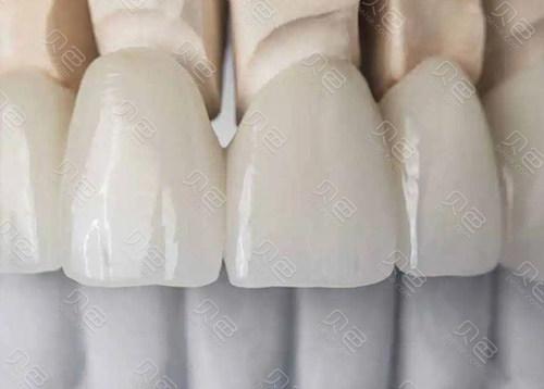 中山石岐口腔医院牙齿种植价格表2025版,种植牙费用和材料选择指南(图4)