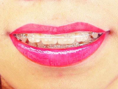 呼和浩特至美口腔牙齿种植价格一览表,内含各系统详细费用!(图2)