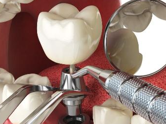 盘锦种植牙医院哪家技术好？精选5家专业牙科机构实力对比！