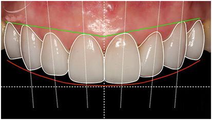 呼和浩特至美口腔牙齿种植价格一览表,内含各系统详细费用!(图4)