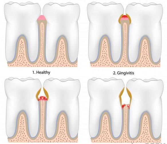 咸阳彩虹医院全瓷牙修复需要磨牙吗?门牙缺损修复价格解析(图3)