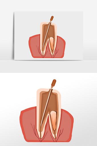 包头牙齿种植一颗价格多少钱？包头地区种植牙通常需要7370到19886元左右
