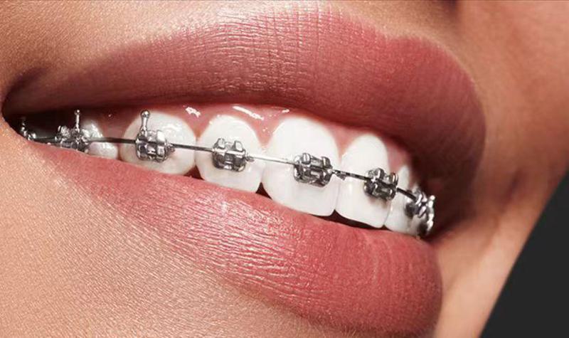 杭州西湖口腔医院怎么样?补牙-矫正-种植收费明细,价格透明!(图3)