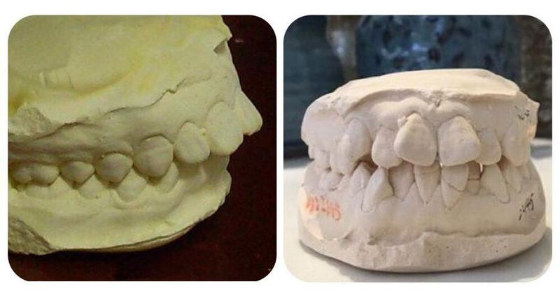 深圳明森齿科牙齿矫正多少钱？2025矫正价格全解析，金属托槽-隐形矫正收费明细