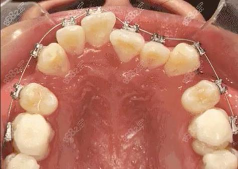 株洲牙齿矫正哪家医院好？荷塘-天元-芦淞区这5家专业口腔机构值得选！(图3)