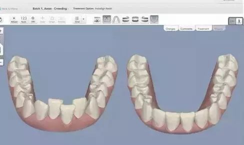 深圳明森齿科牙齿矫正多少钱？2025矫正价格全解析，金属托槽-隐形矫正收费明细(图2)
