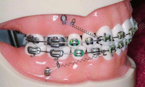 牙齿矫正5000和10000区别：从材料、医生资质、矫正方式、效果持久性等多维度深度解析！