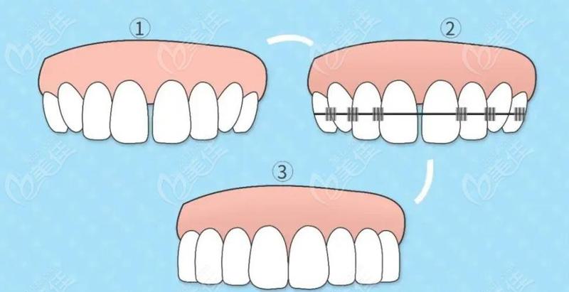 福州牙齿矫正医院哪家好？这份技术强、收费透明的牙科名单请收好！