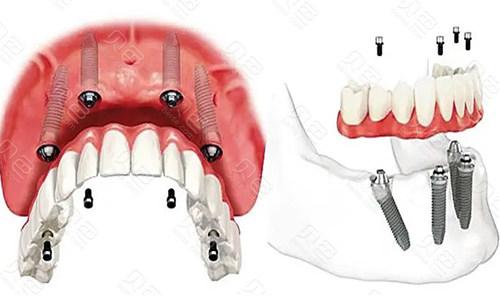淄博张店区靠谱口腔机构盘点，诺尔漫-中心医院-四叶草-博瑞-盛德仁口腔实力上榜！(图2)
