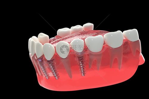 种植牙与烤瓷牙有什么区别?从优缺点全面解析种植牙与烤瓷牙的不同选择!(图4)