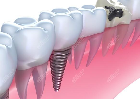想在昆明做种植牙手术?这五家专业口腔医院收费透明位置便利!(图2)