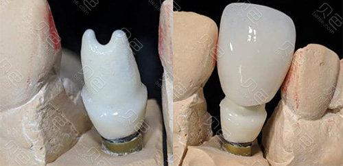 合肥种植牙价格表2025最新版:不同品牌收费及医院特色解析(图1)