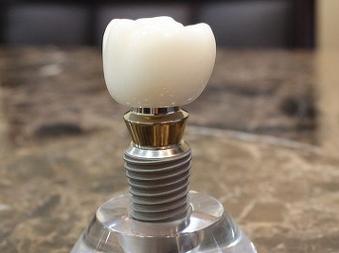 时代天使牙套价格贵吗？经典版25000+冠军版30000+！专业医生解析优势与适用人群(图1)