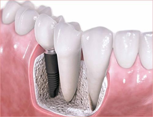 昆明松鼠口腔价格明细表：种植牙6600元起、自锁托槽矫正11209元起、补牙200元起