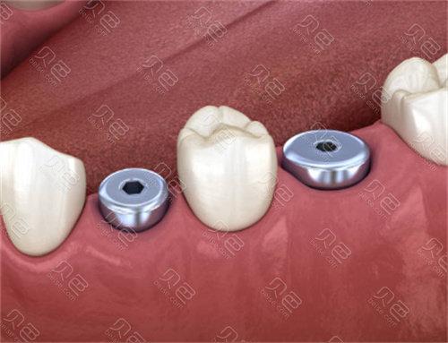 咸阳海涛口腔医院数字化矫正种植技术获赞誉,患者反馈牙齿矫正与种植牙效果显著值得推荐!(图4)