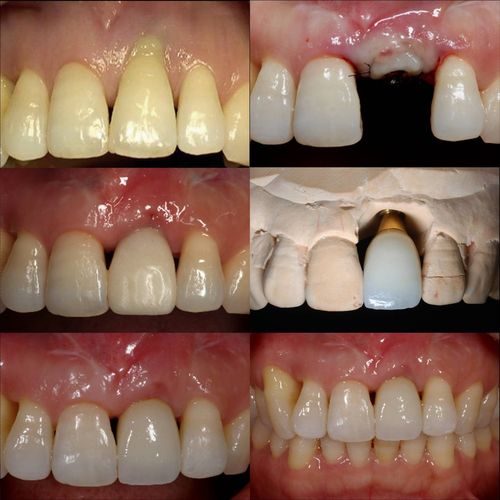 2025年以色列种植牙品牌权威盘点：雅定、abt、mis等五大品牌技术特点与价格对比分析(图1)