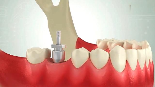 杭州正合口腔2025最新价格表公布！种植牙5000元起+隐形矫正22000元起+全瓷牙1400元起