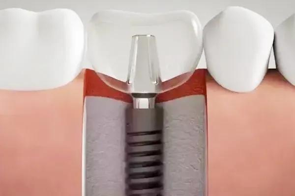 拔牙种牙哪家强?三亚雅福口腔新型设备+真实案例解析,这份专业指南请收好!(图3)