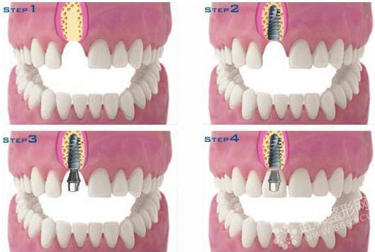 佛山种牙哪家好?2025年正规种植牙医院排名榜单出炉,技术专业,服务贴心!(图3)