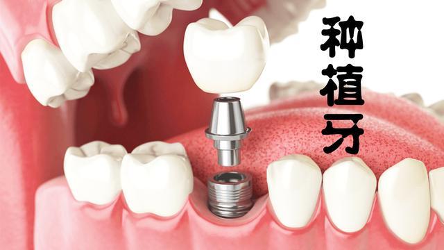 佛山种牙哪家好？2025年正规种植牙医院排名榜单出炉，技术专业，服务贴心！