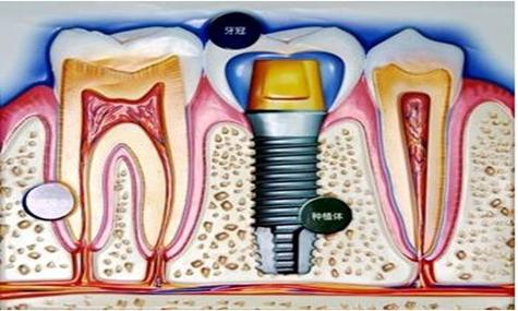 宜昌哪里做牙齿种植效果好？牙齿种植选择宜昌汪万年口腔-宜昌和谐口腔更放心