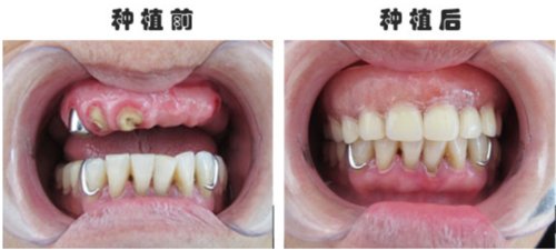 佛山中大口腔医院牙齿种植怎么样?技术怎么样?价格贵不贵?(图2)