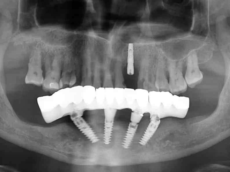 咸阳海涛口腔医院数字化矫正种植技术获赞誉,患者反馈牙齿矫正与种植牙效果显著值得推荐!(图3)