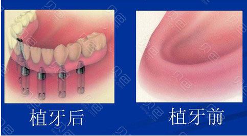 驻马店种植牙多少钱一颗？2025年驻马店种牙好医院收费详情公开(图3)