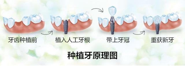 武汉牙齿矫正哪家强?武汉大众口腔医院专业可靠,矫正种植一站式解决(图4)