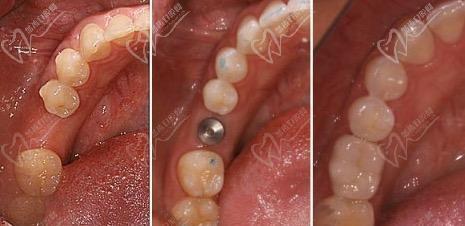 绵阳涪城区种植牙哪家好？2025最新价格表公布，这几家性价比超高！(图1)