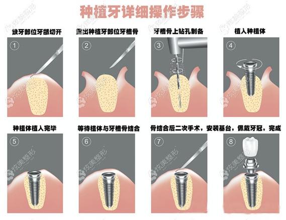 这份绵阳经开区种植牙价格表告诉你牙齿种植多少钱一颗才合理(图2)